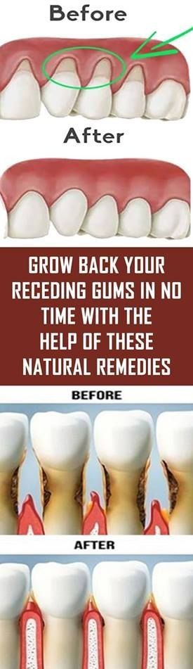 GROW BACK YOUR RECEDING GUMS IN NO TIME WITH THE HELP OF THESE NATURAL REMEDIES